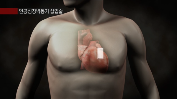 ◇ 부정맥 치료 방법 중 하나로는 인공심장박동기 삽입술이 있다.                                                       *출처=EBS