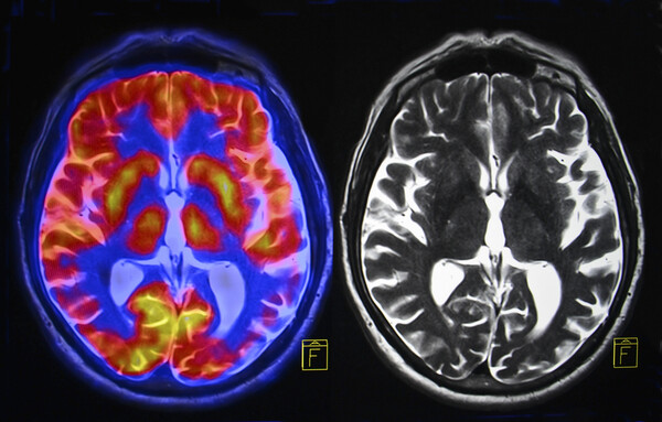 뇌를 스캔한 MRI 사진 . 연구결과 뇌 회색질 얇을수록 치매 가능성이 높아졌다.    /셔터스톡 